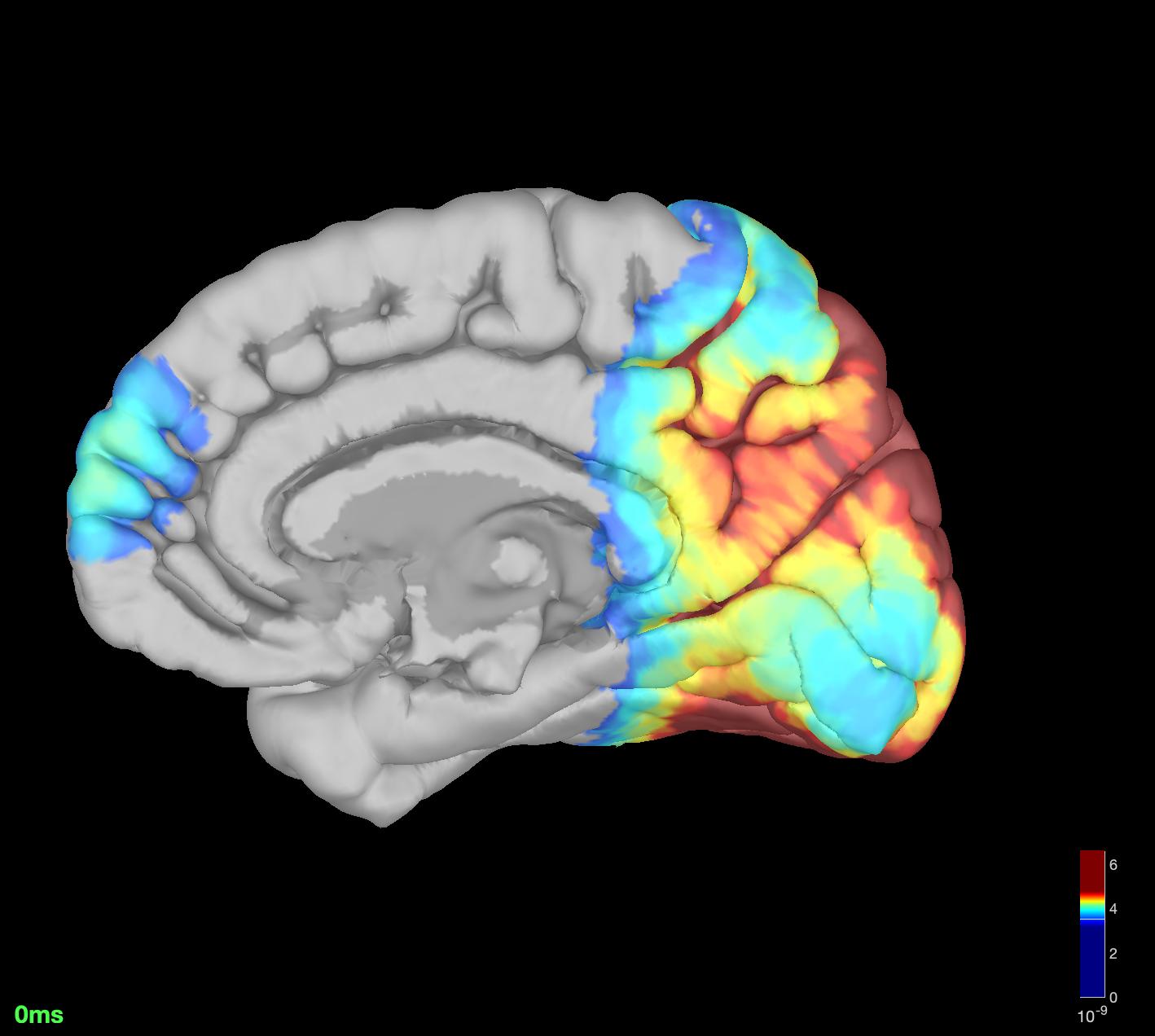 Mapeo cerebral en Biofeedback Center®:  Localización de las fuentes en una persona perteneciente al espectro autista. Copyright© Bfc®