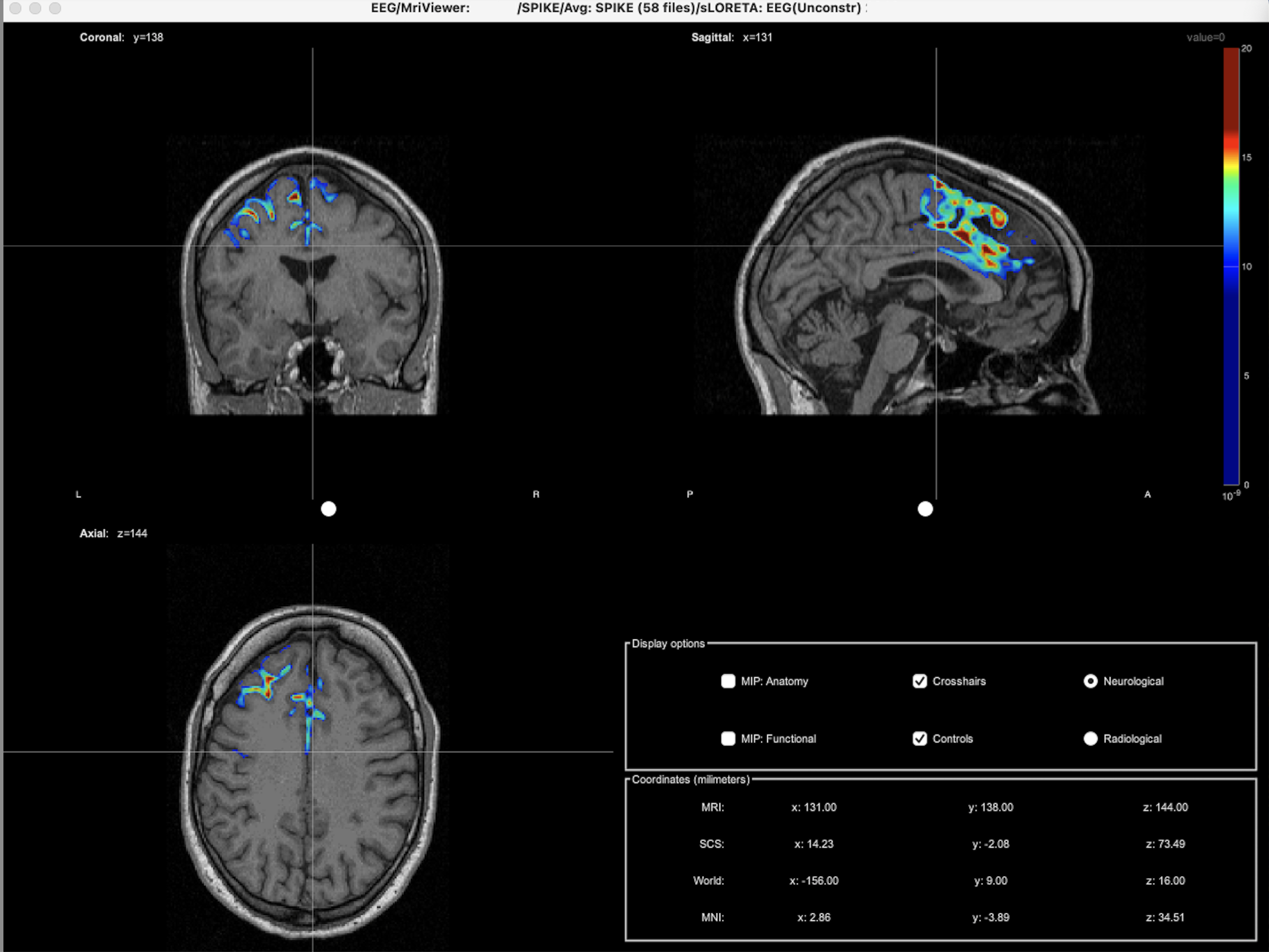 Mapeo cerebral en Biofeedback Center®:  cómputo de las fuentes en la superficie de la corteza cerebral y mostradas en el visor de la RM, corresponsientes a una descarga epileptógena. Copyright© Bfc®