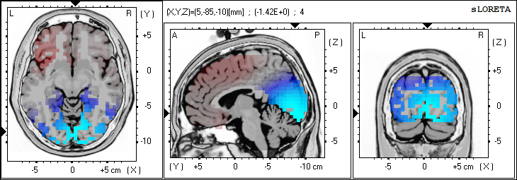 Mapeo cerebral en Biofeedback Center®: localización de las fuentes de la actividad alfa (α 8-13 Hz) con los ojos cerrados. Copyright© Bfc®