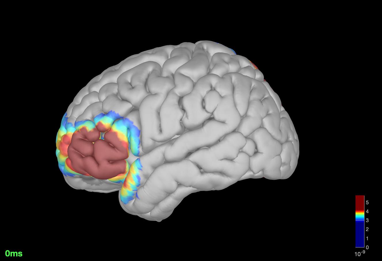Mapeo cerebral en Biofeedback Center®: localización de las fuentes de la actividad delta (∂ .1-4 Hz) en una persona que pertenece al espectro autista. Copyright© Bfc®