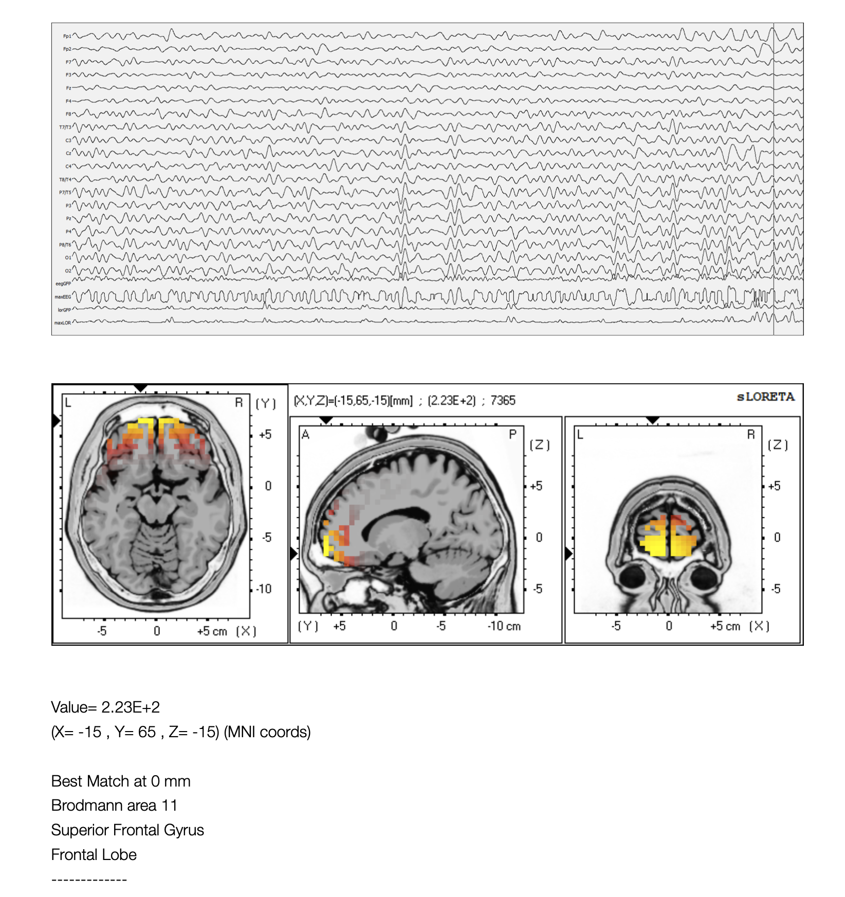 Mapeo cerebral en Biofeedback Center®: localización de las fuentes en un paciente con dependencia severa alcohol y el canabinol. Copyright© Bfc®
